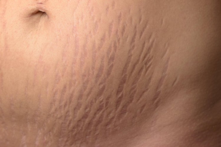Stretch Marks During and After Pregnancy